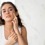 Navigating Acne