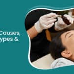 Acne Scars Treatment Causes, Diagnosis, Types & Treatment