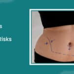 Cryolipolysis Treatment Procedure, Risks & Benefits