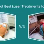 Laser Treatments for Face