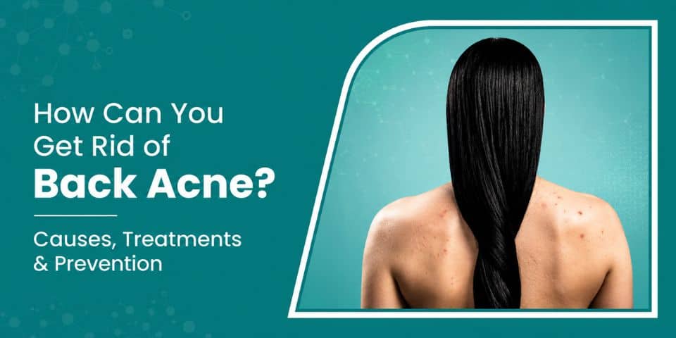 How Can You Get Rid of Back Acne